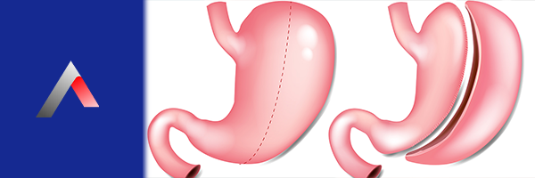 Mide tüpü (Gastrik Sleeve)